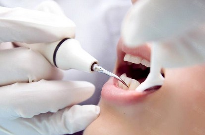 洗牙后关注的事项,洗牙后怎样护理不长牙结石