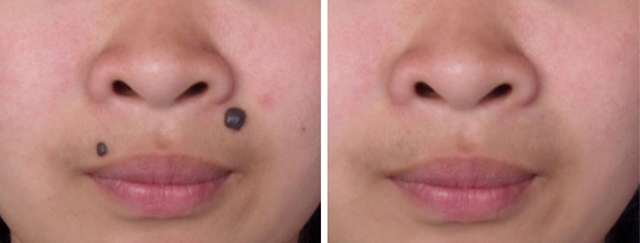 孙红雷曾说：得了黑痣赶紧点，千万别以为是好运和性感！真的吗？