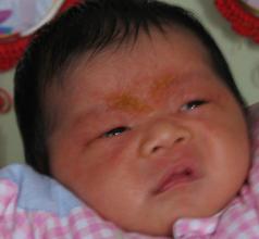 湿疹反复发作代表没找出病因吗,婴儿湿疹的诱发原因