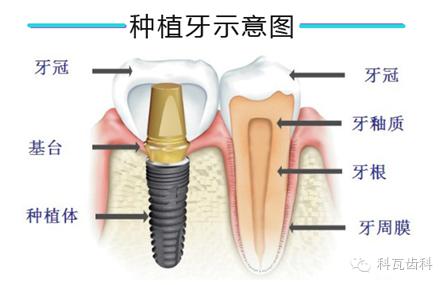缺牙后果,缺牙修复全过程3d演示