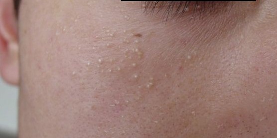 眼睛周围的扁平疣怎么消除脂肪粒,眼睛周围有脂肪粒是胆固醇高吗