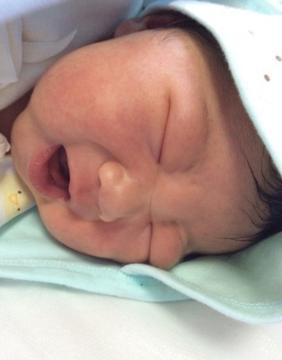 婴儿湿疹奶癣怎么护理,新生儿奶癣跟湿疹可以擦保湿霜吗