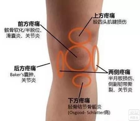 不能轻视的膝关节运动损伤：髌骨软化症