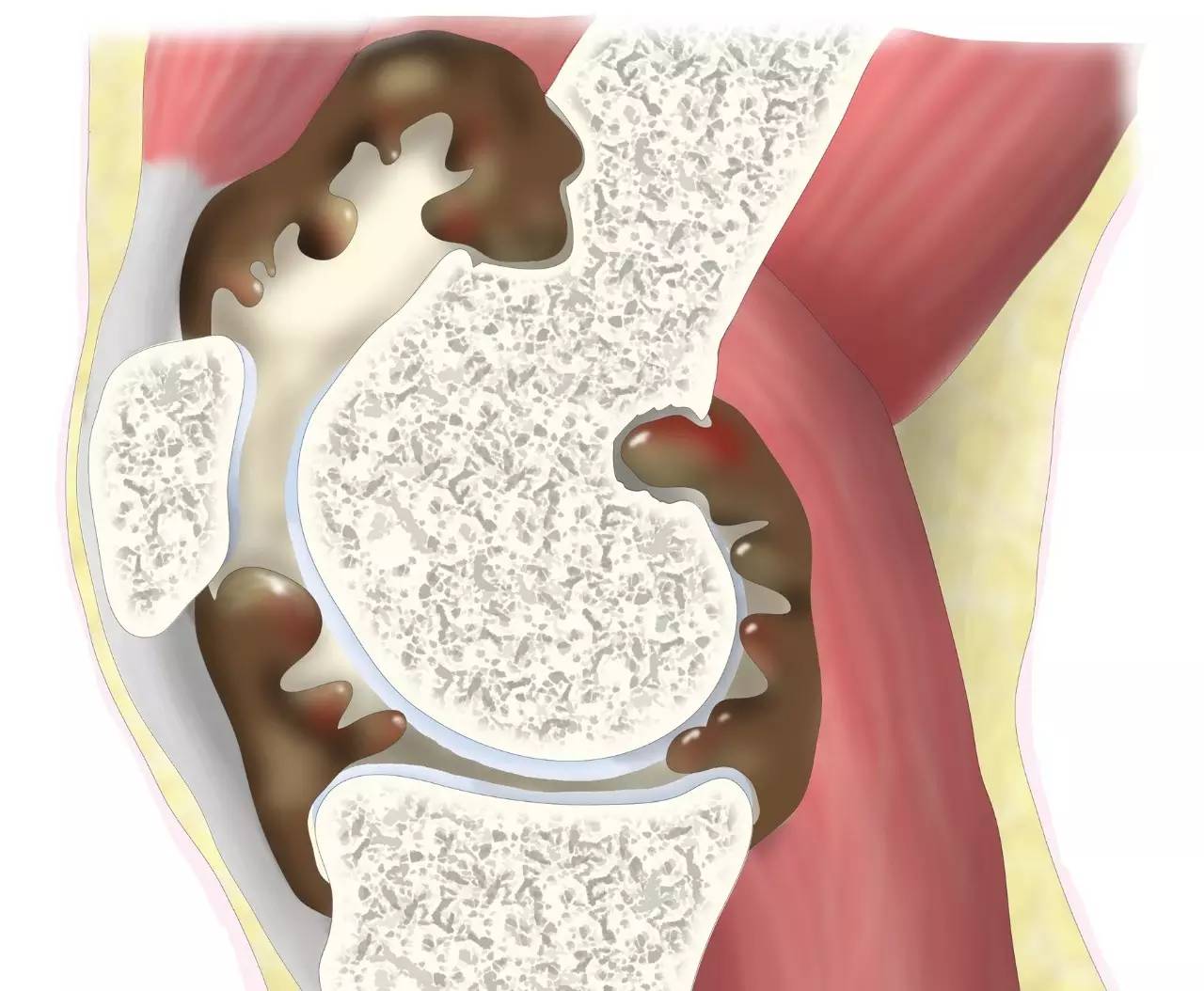 膝关节有积液怎么办吃什么药,膝关节腔及髌上囊积液