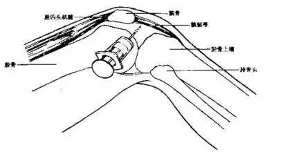 膝关节有积液怎么办吃什么药,膝关节腔及髌上囊积液