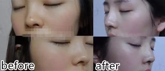 埋线鼻子vs假体隆鼻,隆鼻假体和埋线隆鼻