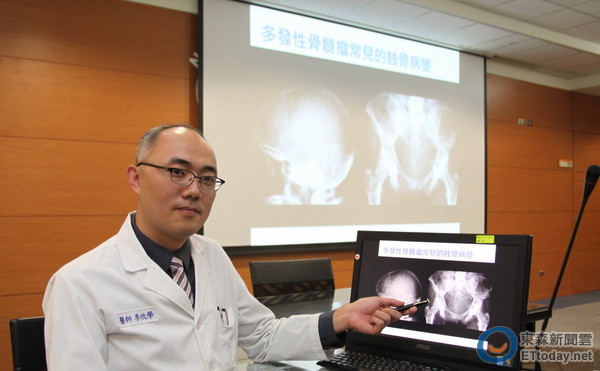 多发性骨髓瘤患者的骨骼,多发性骨髓瘤基因高危