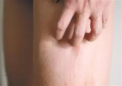 经常胃胀气多放屁是什么原因,容易胀气出汗是怎么回事