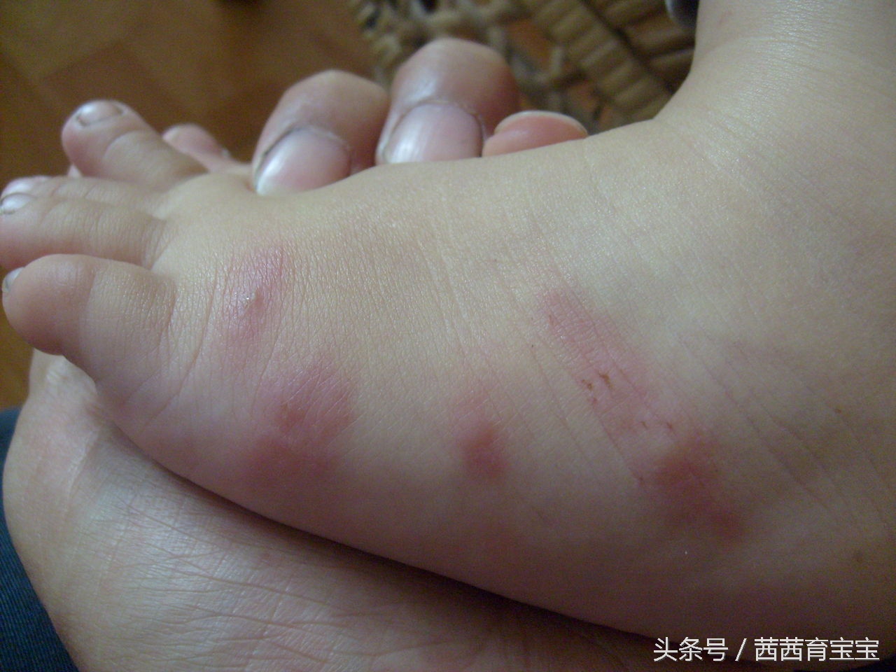 宝宝长湿疹涂什么药膏,宝宝喝奶长湿疹怎么办