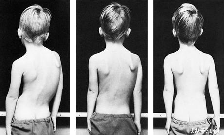 治疗脊柱侧弯去什么医院,脊柱侧弯案例文章分享