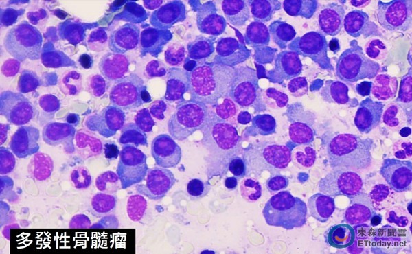 多发性骨髓瘤患者的骨骼,多发性骨髓瘤基因高危