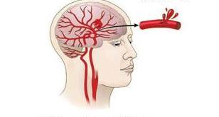 出现脑出血应该关注怎么抢救,脑溢血急救方法和技巧