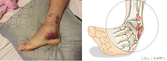 脚踝扭伤了不能走路怎么恢复最快,脚踝扭伤影响运动功能吗