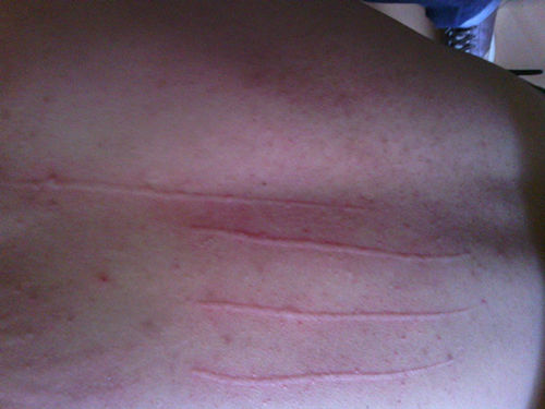 荨麻疹针刺治疗方法,荨麻疹的西医治疗方法