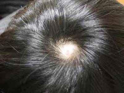 22岁小伙因斑秃或失女友，15年专家临床经验倾囊相授辩证施治