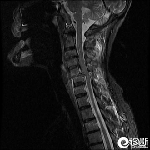 最严重颈椎骨折怎么治疗,ai诊断肋骨骨折