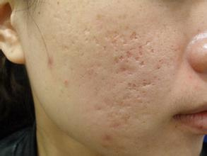 痘印痘坑怎么去除最有效的方法,男士痘坑痘印修复的最佳方法