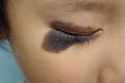 孙红雷曾说：得了黑痣赶紧点，千万别以为是好运和性感！真的吗？