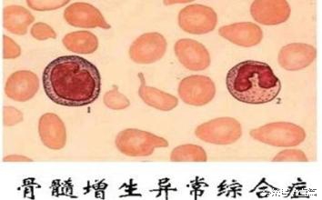 mds骨髓增生异常综合征的有效治疗,骨髓增生异常综合征mds