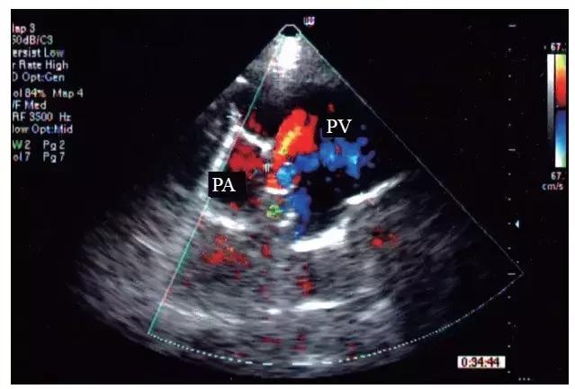 动静脉瘘超声频谱特征,超声动静脉瘘的描述