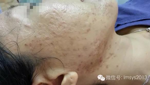 中医火针疗法治疣,中医实战笔记扁平疣秘方