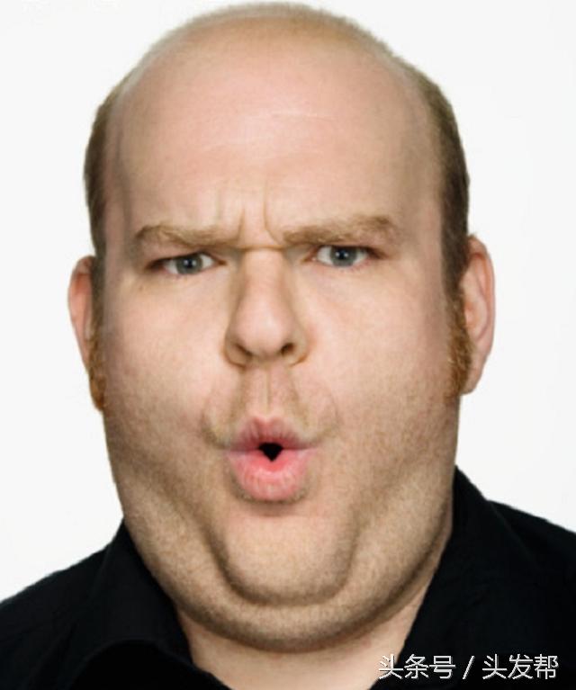 秃顶是什么遗传方式,秃顶是什么原因造成的女生