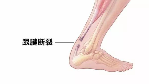 看看丘妈的伤口，跟腱断裂到底是什么？