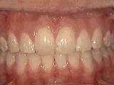 龅牙虎牙矫正的全过程,前牙凸矫正牙齿的全部过程