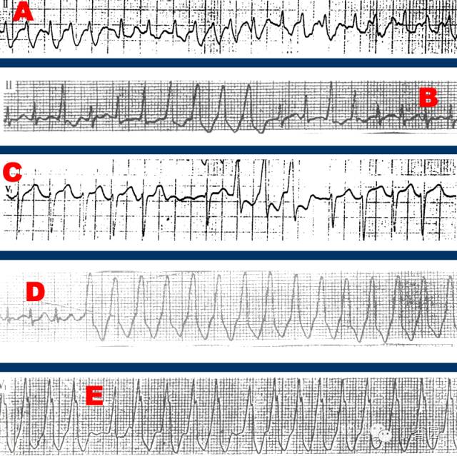 心电图上出现宽大的qrs波,心电图窄波和宽波