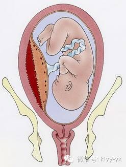 孕期出血有哪些危险,孕期阴道出血的症状