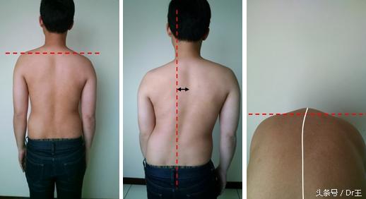 治疗脊柱侧弯去什么医院,脊柱侧弯案例文章分享