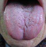 视察舌象的方法,一招教你看舌象图