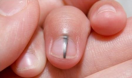 孙红雷曾说：得了黑痣赶紧点，千万别以为是好运和性感！真的吗？