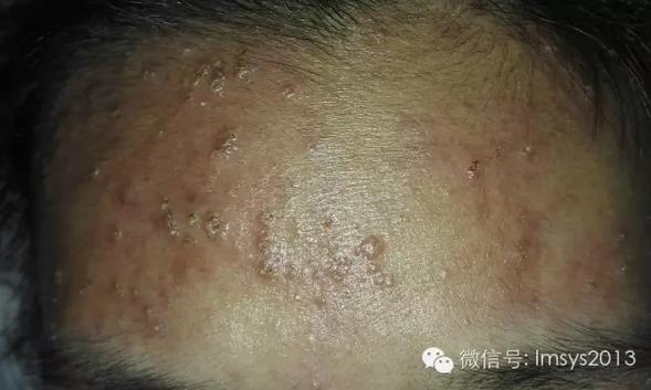 中医火针疗法治疣,中医实战笔记扁平疣秘方