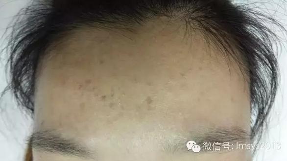 中医火针疗法治疣,中医实战笔记扁平疣秘方