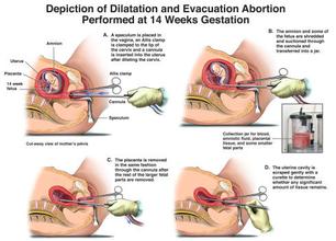 怎么预防人流手术后的并发症,怎么预防人流有残留