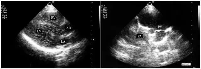 动静脉瘘超声频谱特征,超声动静脉瘘的描述