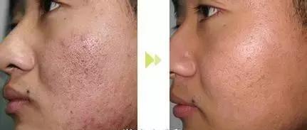 痘痘肌需知的小常识,痘痘肌避免哪些护肤误区