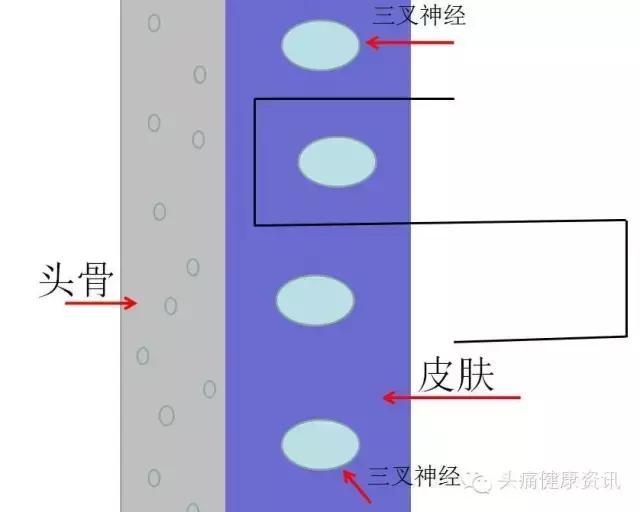 电疗头痛仪,头痛用低频电子治疗仪