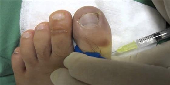 脚突然就出汗发臭,脚没烂不痒却散发出臭味