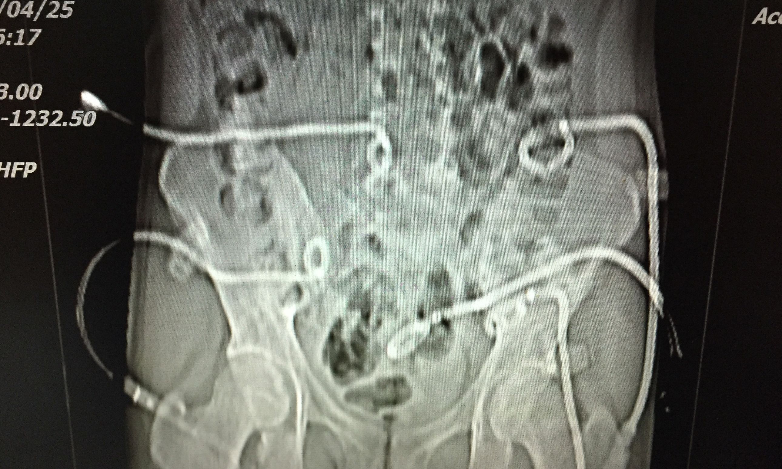你知道吗？脊柱、盆腔结核脓肿可以穿刺引流联合抗痨治疗。