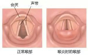 你不知道的宝宝小知识,小宝宝急性喉炎怎么治疗