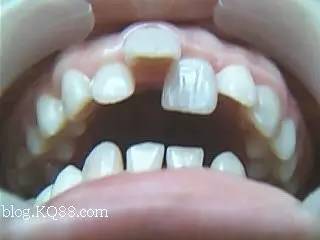 讲解换牙视频,换牙科普知识幼儿园