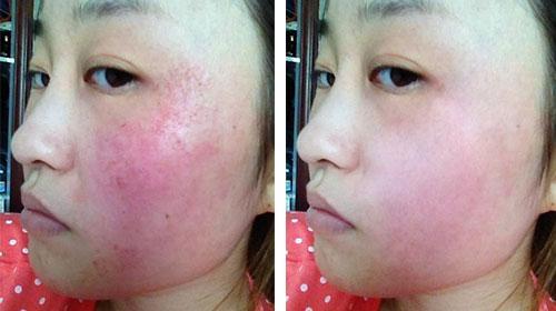 激素脸毛孔特别粗大怎么治疗,激素脸总是干燥起皮很痒怎么修复