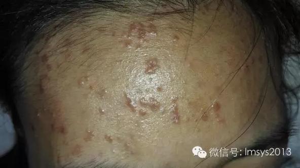 中医火针疗法治疣,中医实战笔记扁平疣秘方