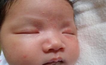 婴儿湿疹的正确护肤方法,婴儿治疗湿疹的民间土方大全