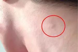 脖子上长了淋巴结要该怎么治,脖子淋巴结和腋下淋巴结都有肿大