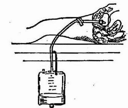 女性结扎恢复的手术过程,女性结扎的手术流程
