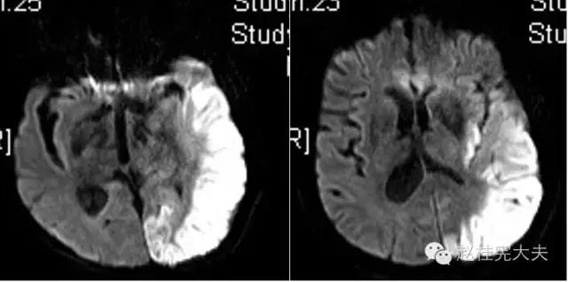 脑卒中简单科普,年轻人是不是不要担心脑卒中