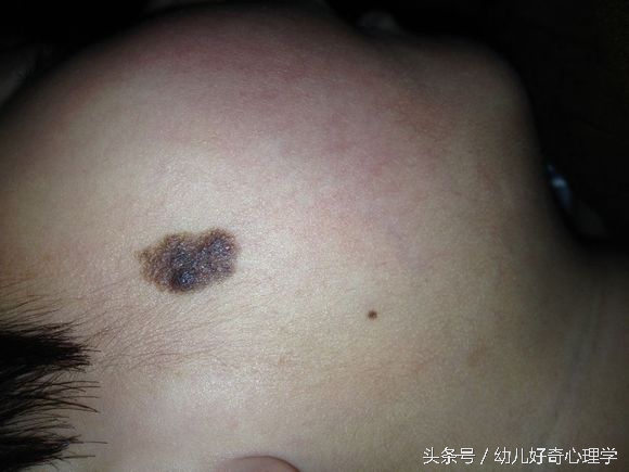 为什么有些婴儿会有胎记,为什么有的婴儿会有胎记